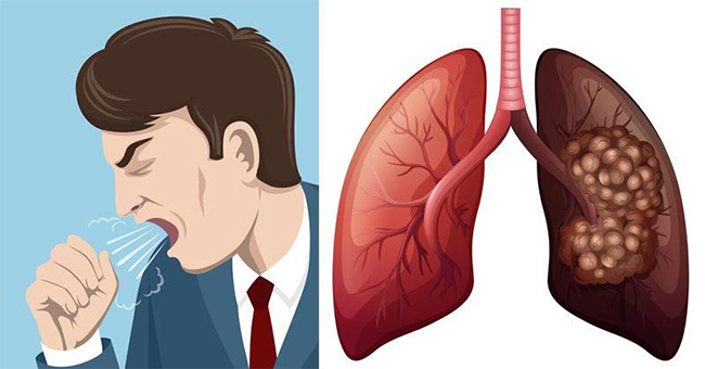 U phổi – Căn bệnh có xu hướng ngày càng tăng nhanh trên toàn cầu